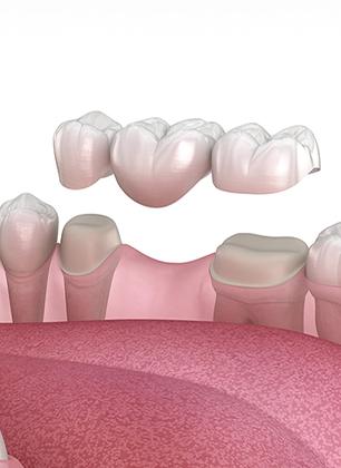 Dental Bridges | Dental at the Bow | General Family Dentist | Downtown Calgary, AB