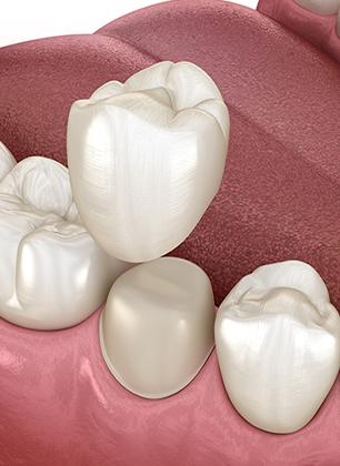 Dental Crowns | Dental at the Bow | General Family Dentist | Downtown Calgary, AB