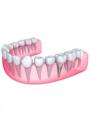 Dental Implants | Dental at the Bow | General Family Dentist | Downtown Calgary, AB