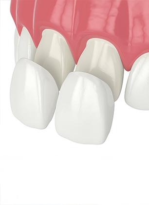 Porcelain Veneers | Dental at the Bow | General Family Dentist | Downtown Calgary, AB